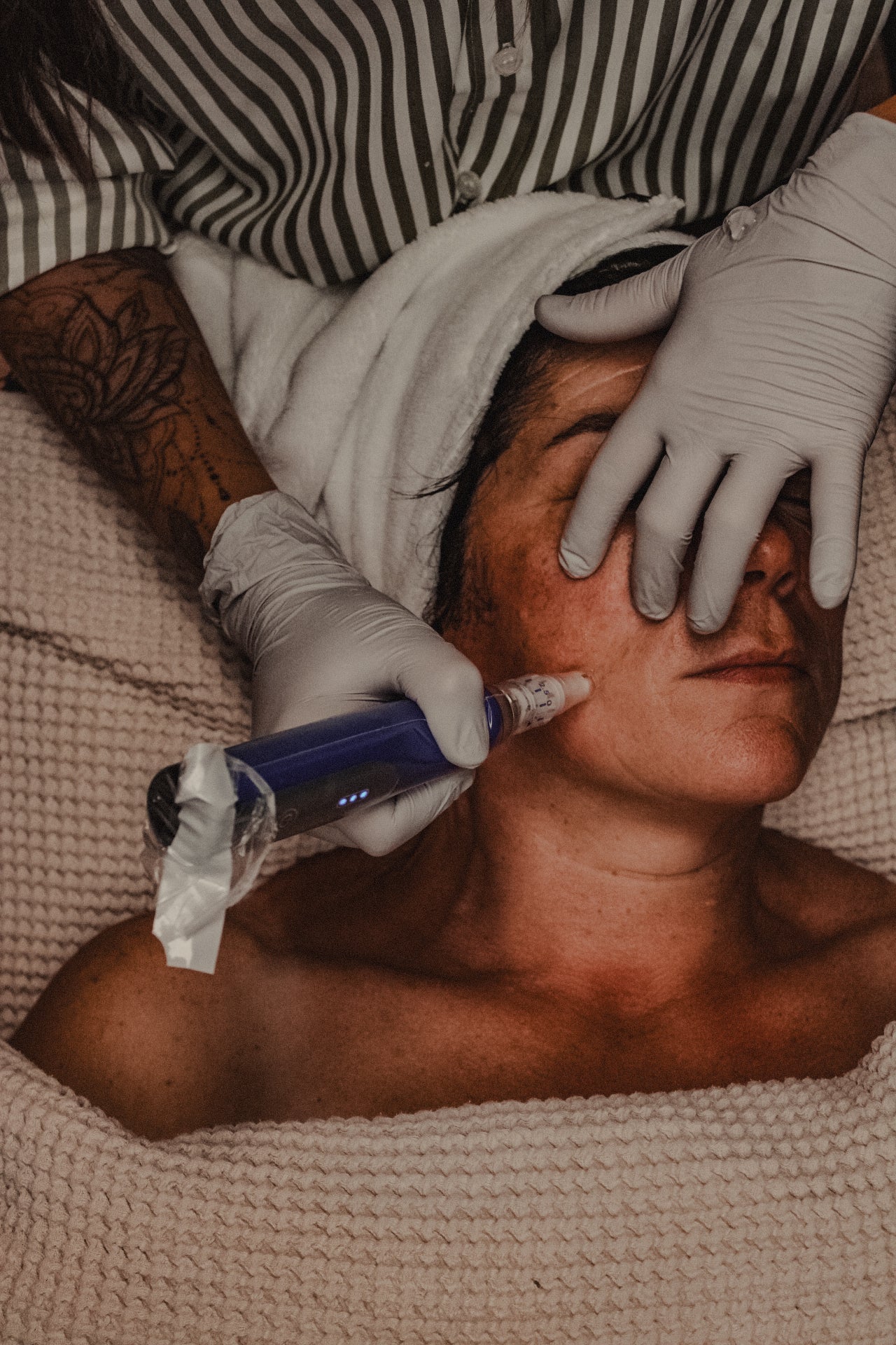 hierbij gebruiken we de skin pen op de huid 